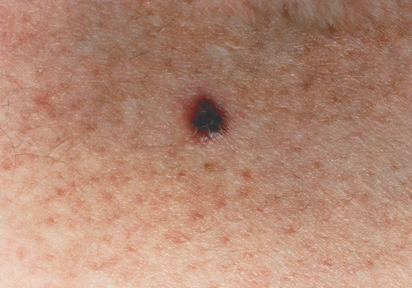 Estagios iniciais melanoma